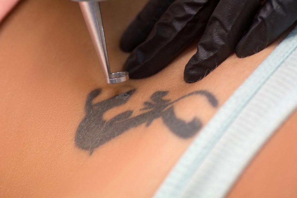 Tratamento cirurgico - remoção de tatuagem